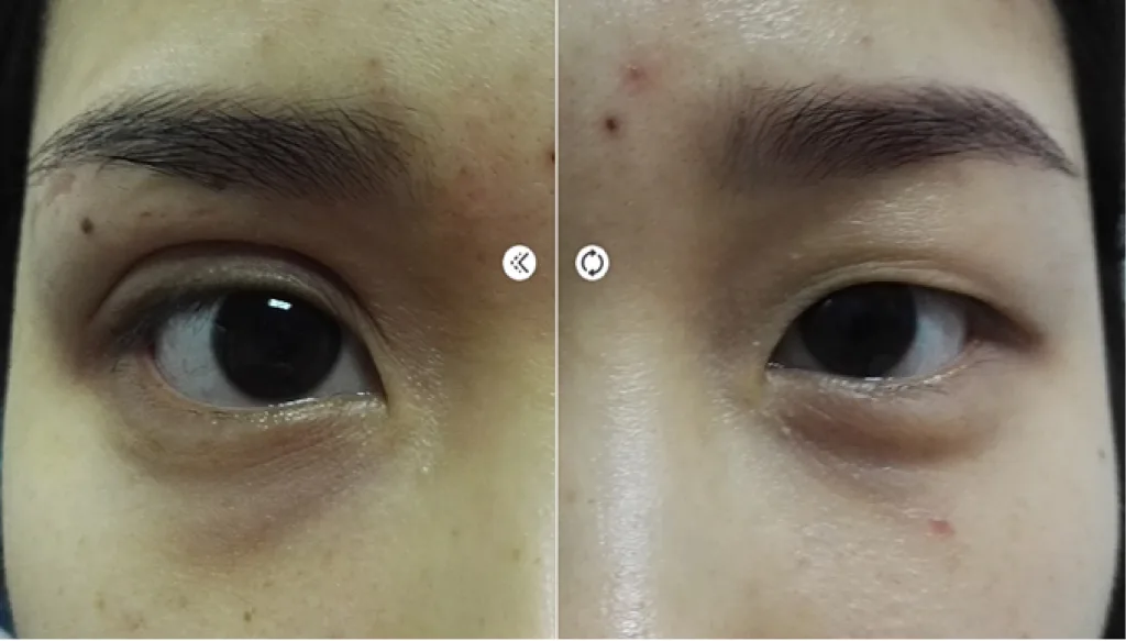 ทำตาแผลเล็ก แผลมินิ