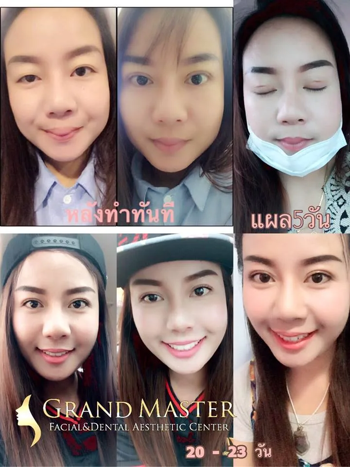 ทำตาแผลเล็ก แผลมินิ ทำตาแผลเล็ก แผลมินิ