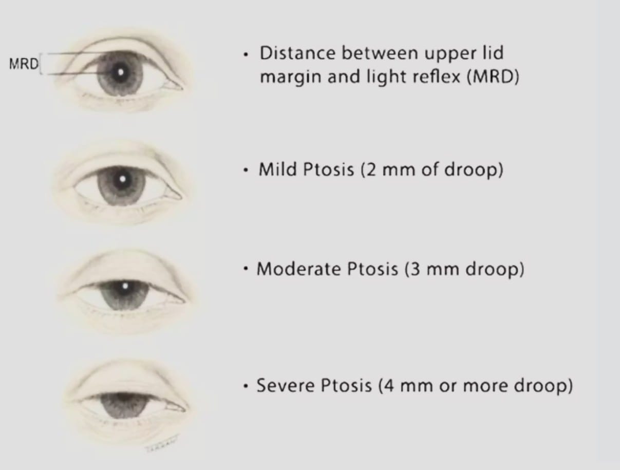 ภาวะกล้ามเนื้อตาอ่อนแรง ภาวะกล้ามเนื้อตาอ่อนแรง