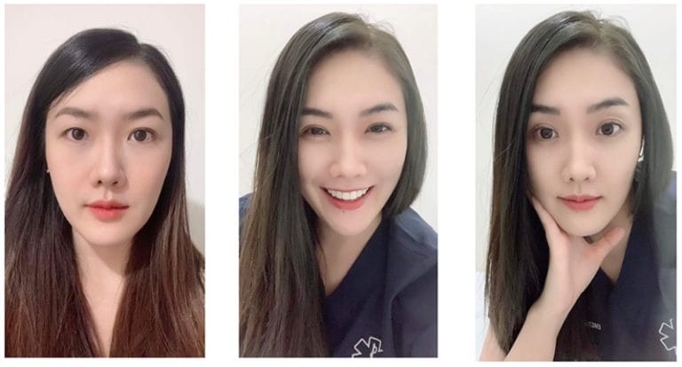 ศัลยกรรมตาชั้นเดียว