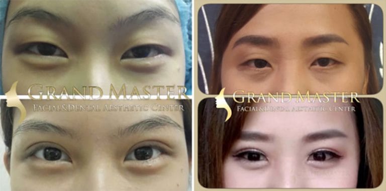 ทำตา ทำตาสองชั้น