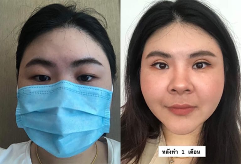 ศัลยกรรมตาชั้นเดียว