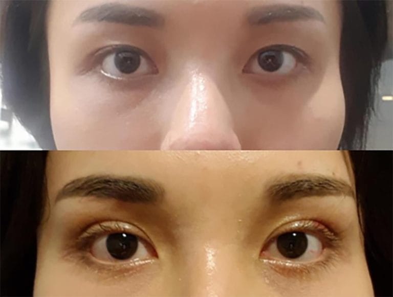 ศัลยกรรมตาชั้นเดียว