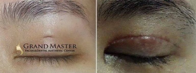 ศัลยกรรมตาชั้นเดียว