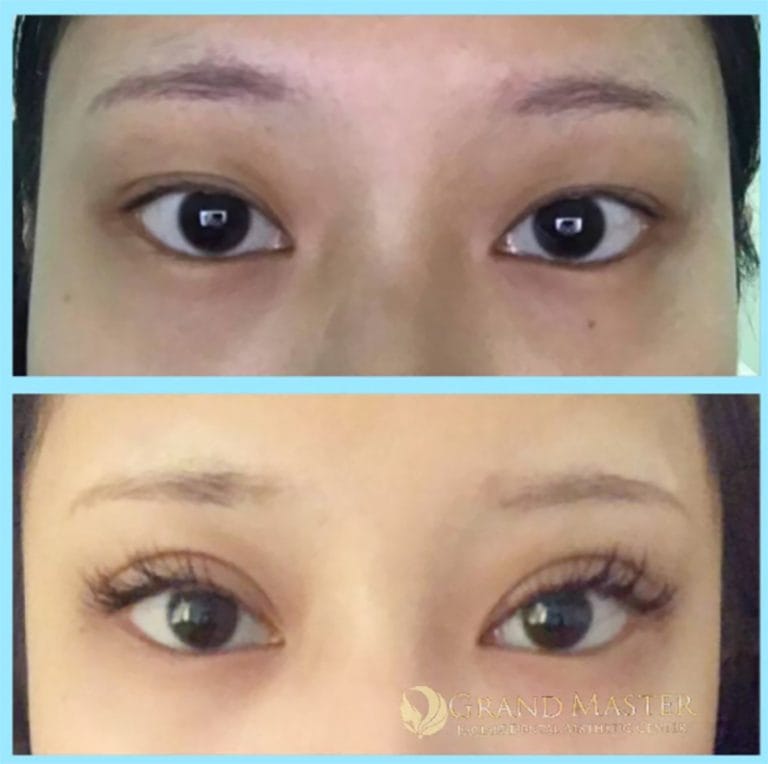 ทำตา ทำตาสองชั้น