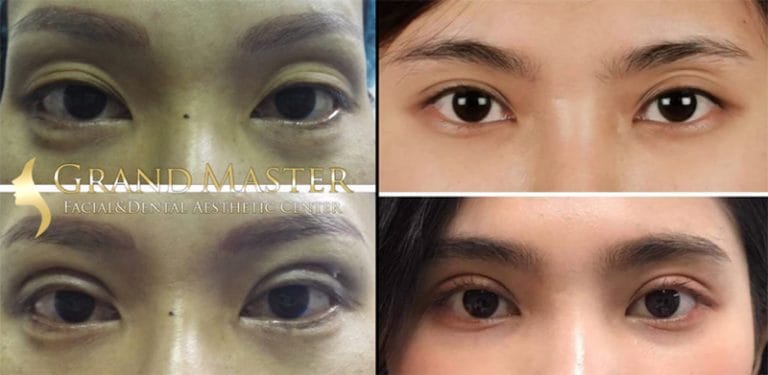 เบ้าตาลึก