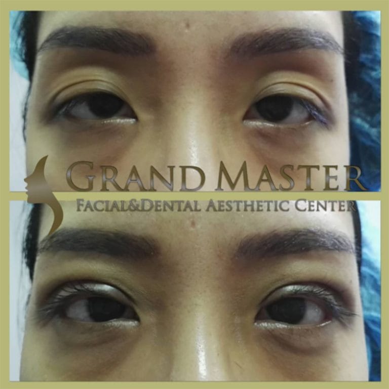 กล้ามเนื้อตาอ่อนแรง