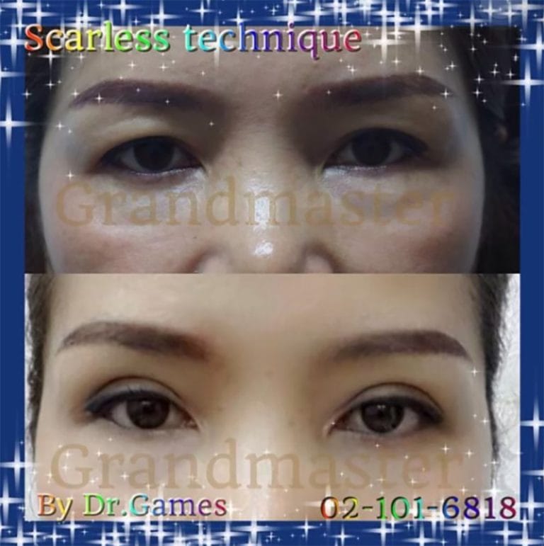 ทำตา ทำตาสองชั้น