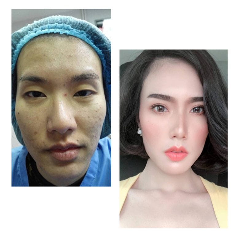 ศัลยกรรมตาชั้นเดียว