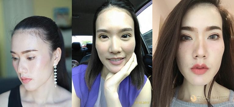 ศัลยกรรมตาชั้นเดียว