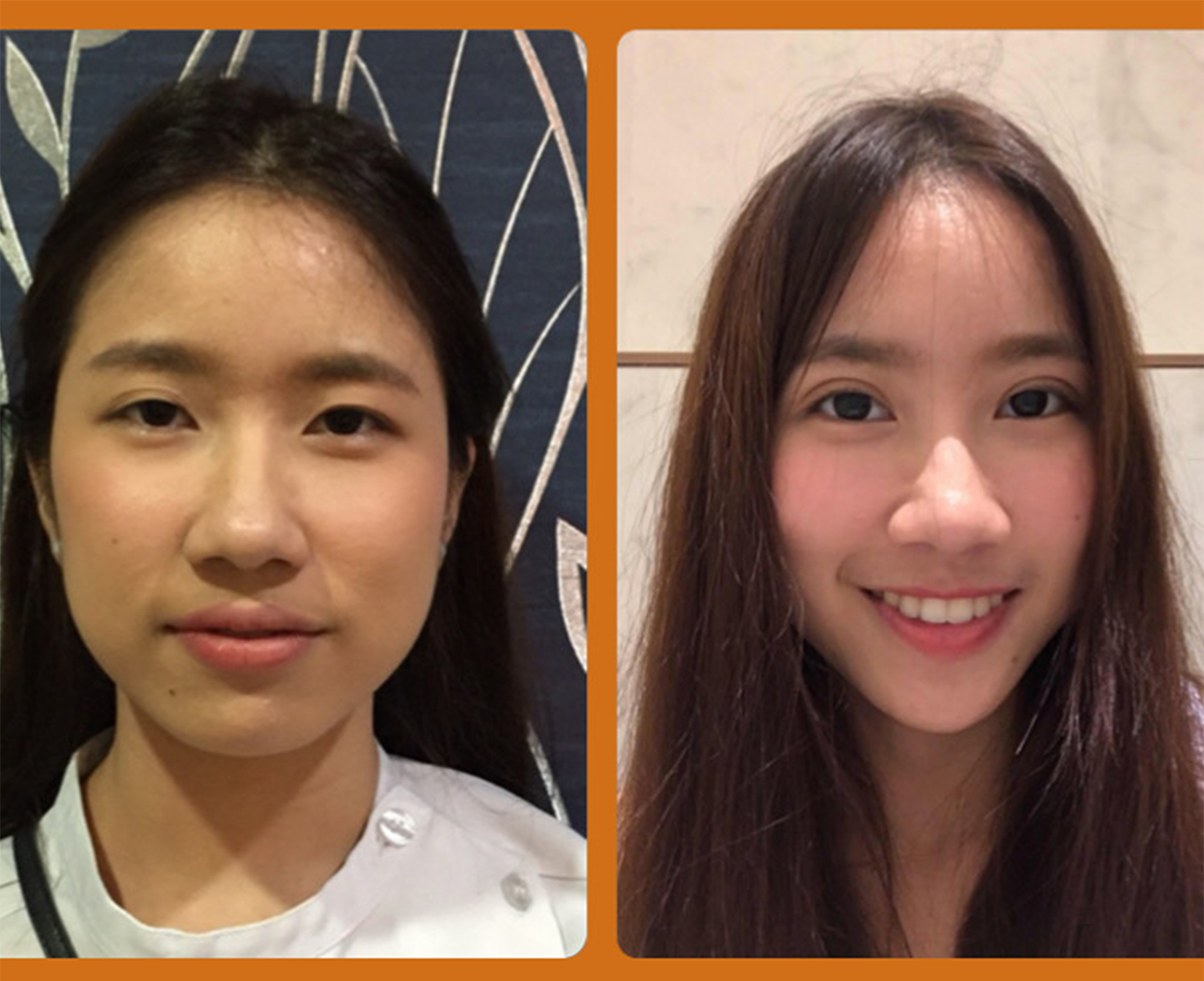 ptosis