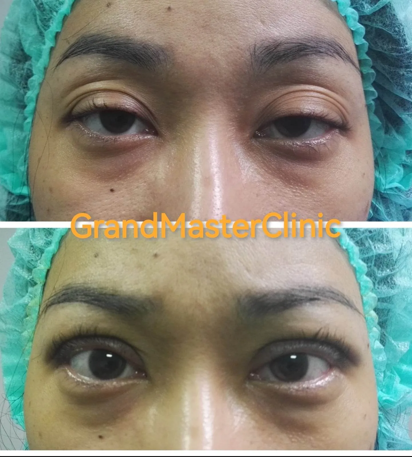 Ptosis