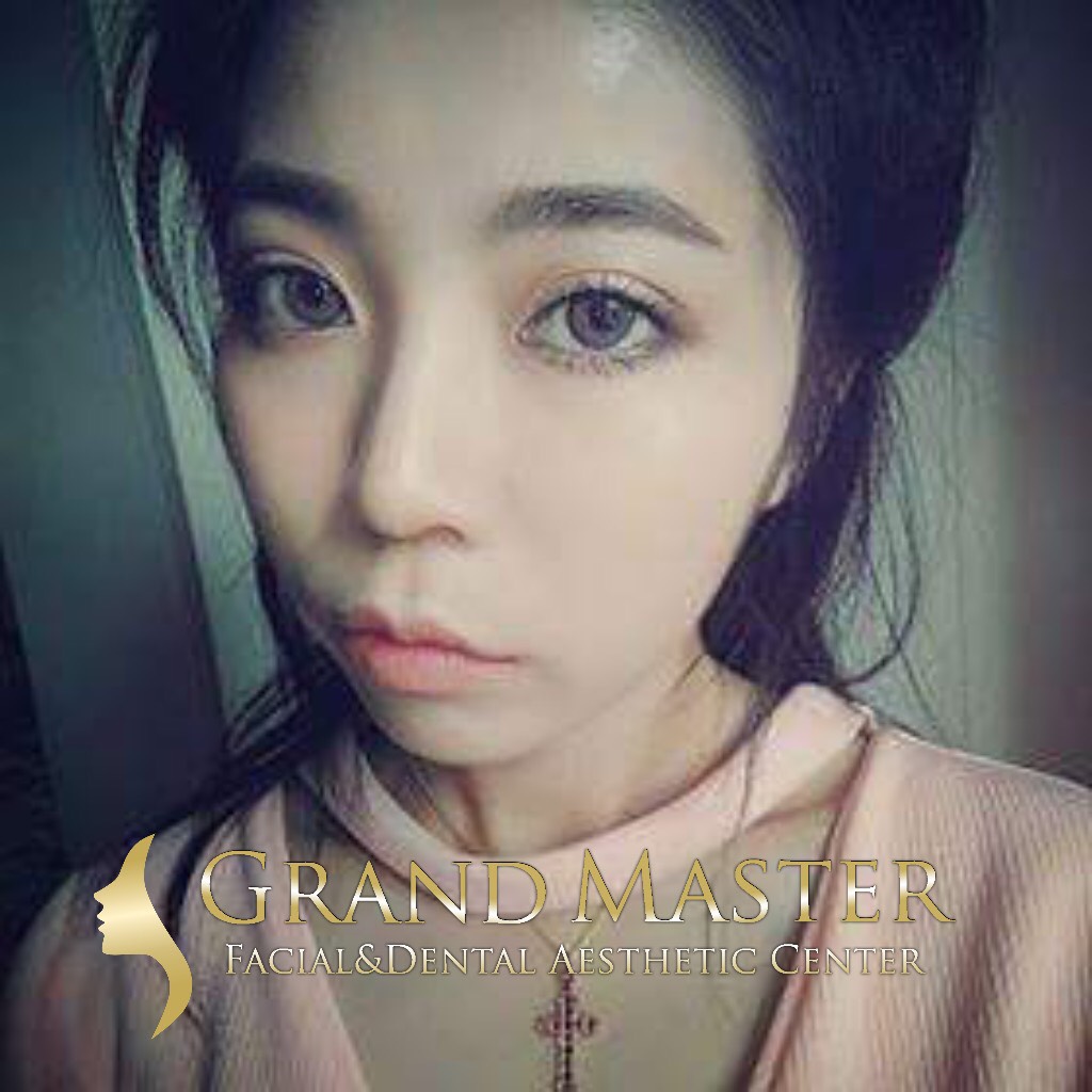 ศัลยกรรมทำตาชั้นเดียว