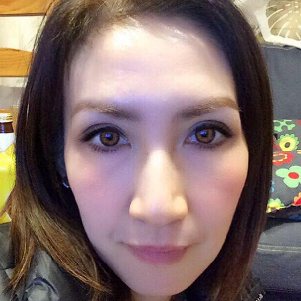 ทำตาสองชั้นบวมกี่วัน