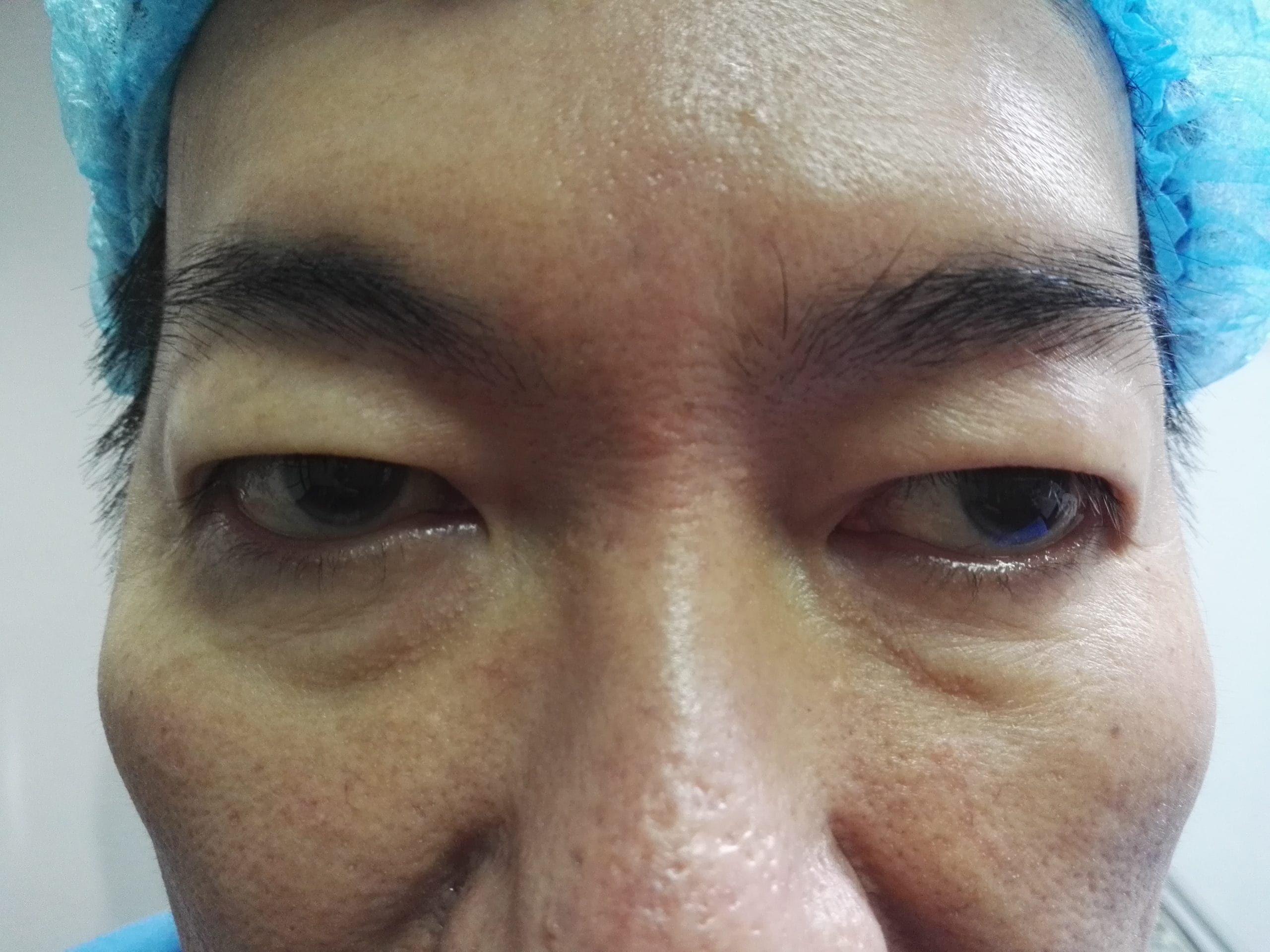 หนังตาตก