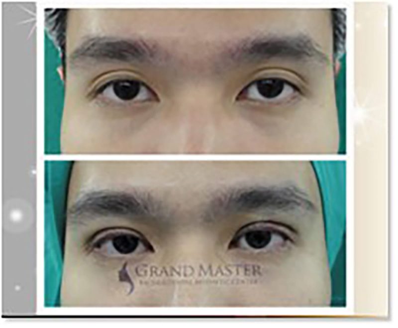 ศัลยกรรมตาชั้นเดียว